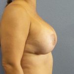 Augmentation Mastopexy Revision Before & After Patient #4724