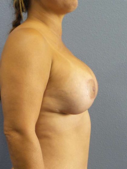 Augmentation Mastopexy Revision Before & After Patient #4724