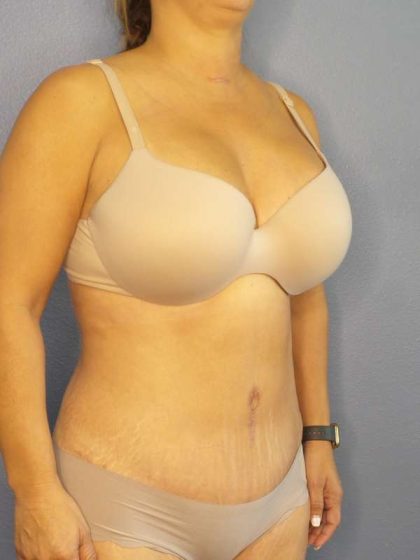 Abdominoplasty Before & After Patient #3654