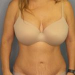 Abdominoplasty Before & After Patient #3654
