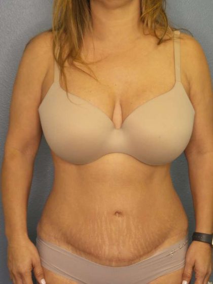 Abdominoplasty Before & After Patient #3654