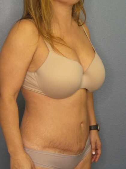 Abdominoplasty Before & After Patient #3654