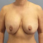 Augmentation Mastopexy Revision Before & After Patient #4724