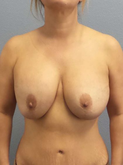 Augmentation Mastopexy Revision Before & After Patient #4724