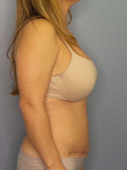 Abdominoplasty Before & After Patient #3654