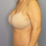 Abdominoplasty Before & After Patient #3654