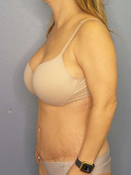 Abdominoplasty Before & After Patient #3654