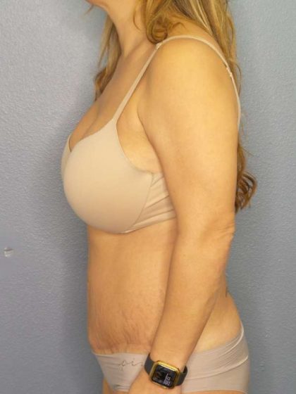 Abdominoplasty Before & After Patient #3654