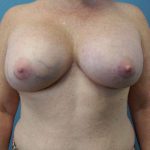 Breast Augmentation Before & After Patient #6305