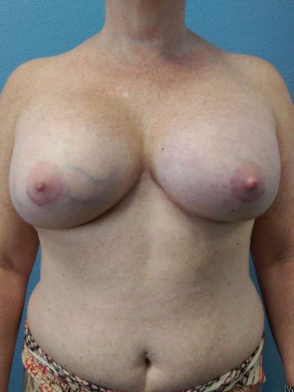 Breast Augmentation Before & After Patient #6305
