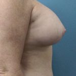 Breast Augmentation Before & After Patient #6305