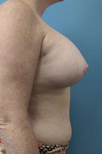 Breast Augmentation Before & After Patient #6305