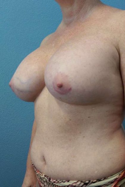 Breast Augmentation Before & After Patient #6305