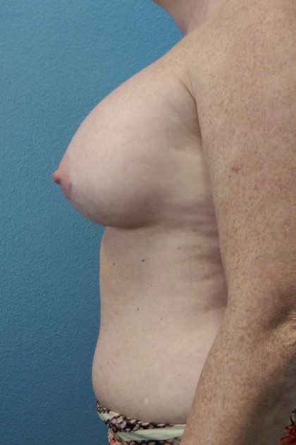 Breast Augmentation Before & After Patient #6305