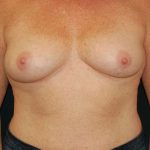 Breast Augmentation Before & After Patient #6305
