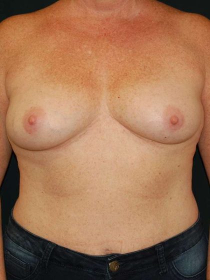 Breast Augmentation Before & After Patient #6305