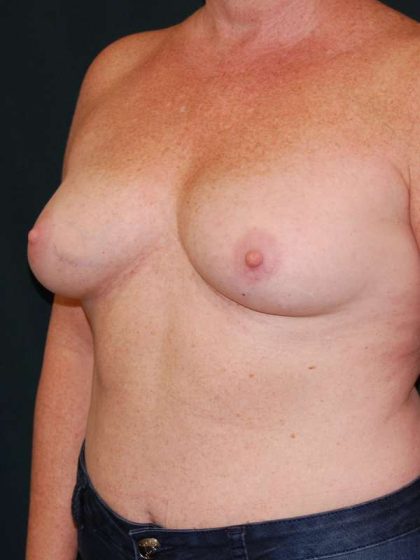 Breast Augmentation Before & After Patient #6305