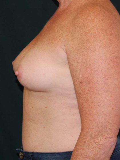 Breast Augmentation Before & After Patient #6305