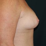 Breast Augmentation Before & After Patient #6305