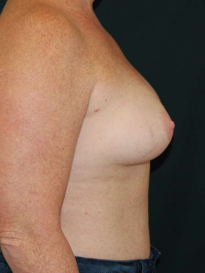 Breast Augmentation Before & After Patient #6305