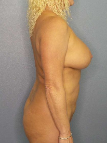 Brazilian Butt Lift Before & After Patient #4893
