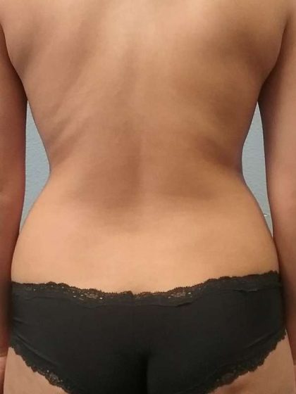 Liposuction Female Before & After Patient #7751