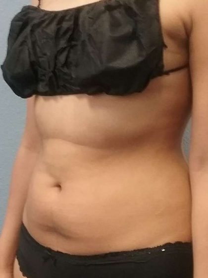 Liposuction Female Before & After Patient #7751