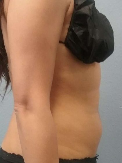 Liposuction Female Before & After Patient #7751