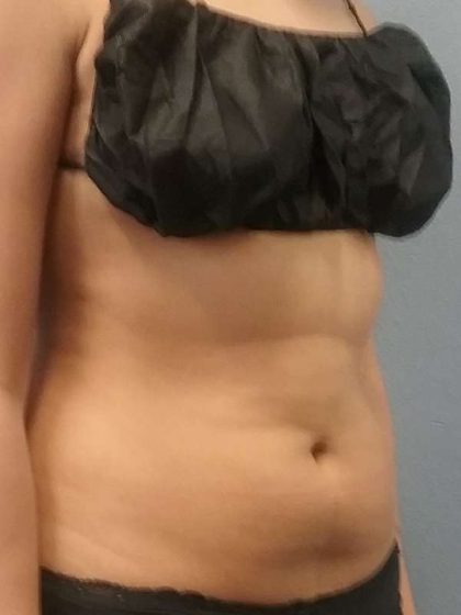 Liposuction Female Before & After Patient #7751