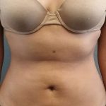 Liposuction Female Before & After Patient #7751