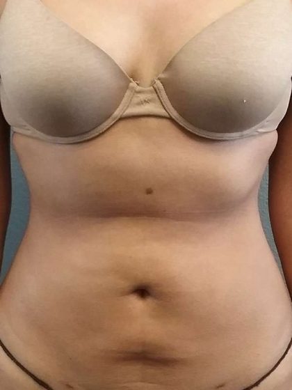 Liposuction Female Before & After Patient #7751