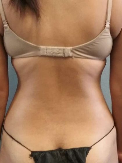 Liposuction Female Before & After Patient #7751