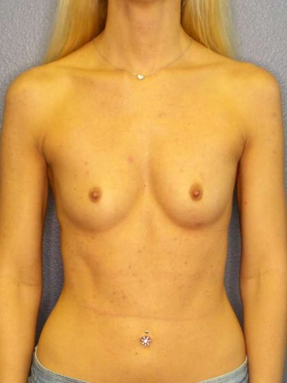 Breast Augmentation Before & After Patient #5513