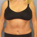 Abdominoplasty Before & After Patient #3751