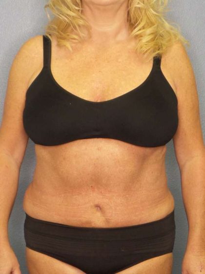 Abdominoplasty Before & After Patient #3751