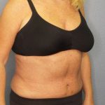 High BMI (Larger Patients) Surgery Before & After Patient #10425