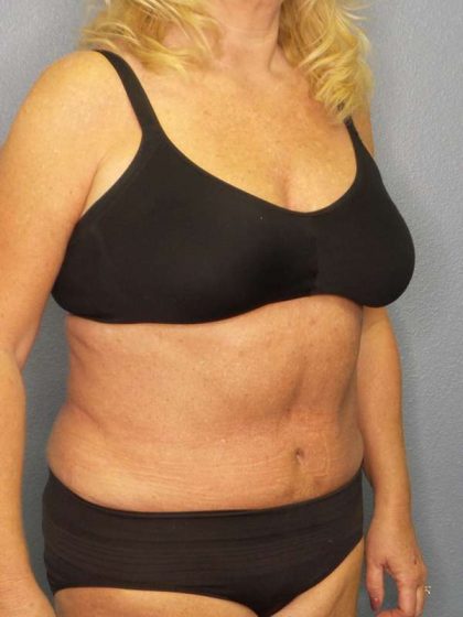 Abdominoplasty Before & After Patient #3751