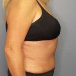 Abdominoplasty Before & After Patient #3751