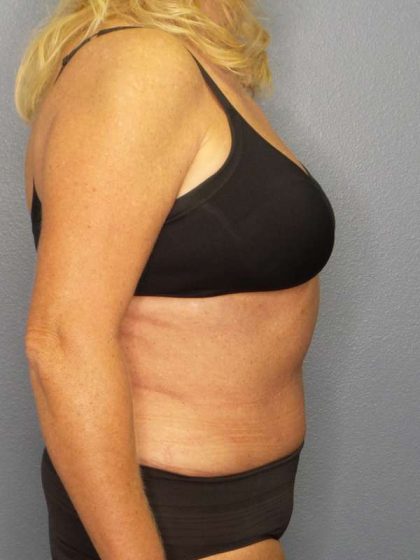 Abdominoplasty Before & After Patient #3751