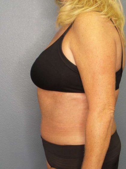 High BMI (Larger Patients) Surgery Before & After Patient #10425