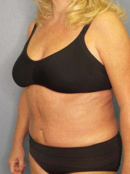 Abdominoplasty Before & After Patient #3751