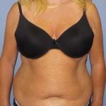 High BMI (Larger Patients) Surgery Before & After Patient #10425