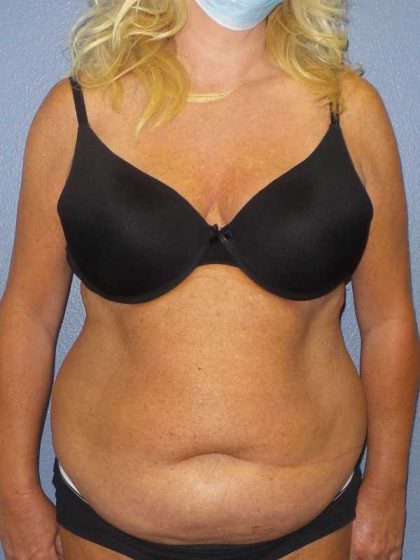 Abdominoplasty Before & After Patient #3751