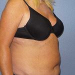 Abdominoplasty Before & After Patient #3751