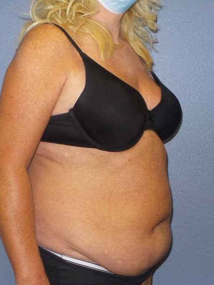 Abdominoplasty Before & After Patient #3751