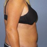 High BMI (Larger Patients) Surgery Before & After Patient #10425