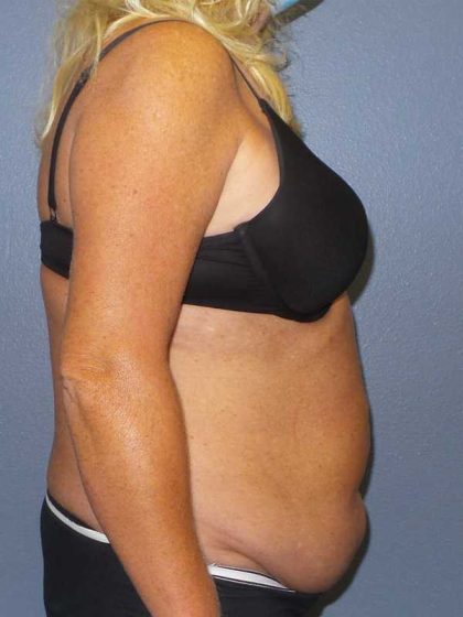 Abdominoplasty Before & After Patient #3751