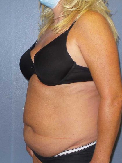 Abdominoplasty Before & After Patient #3751