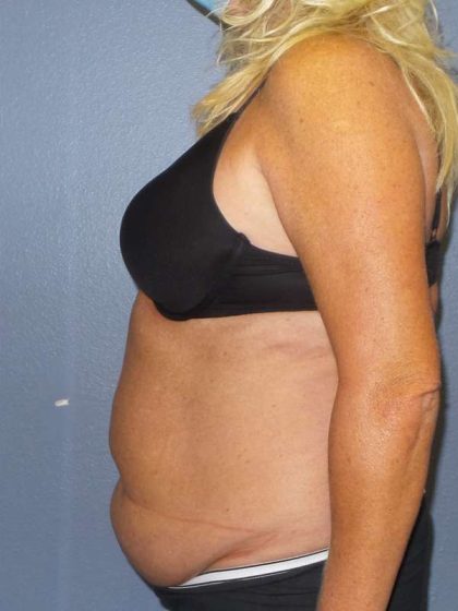 Abdominoplasty Before & After Patient #3751