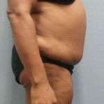Brazilian Butt Lift Before & After Patient #4807